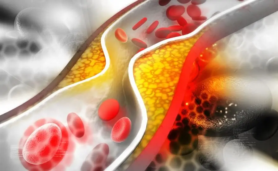 Czy olej roślinny zawiera cholesterol? Co to jest cholesterol i dlaczego jest niebezpieczny?