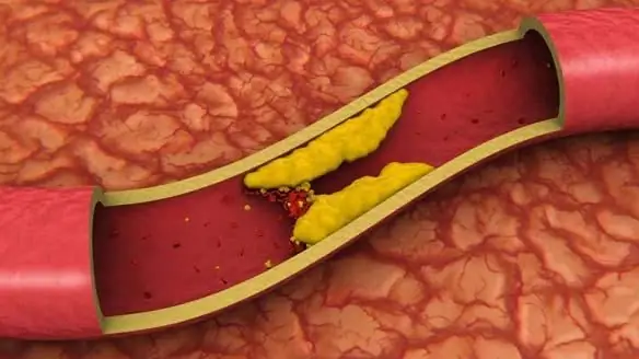 vysoký cholesterol